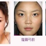 玻尿酸丰眉弓术后需要注意什么?