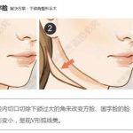 邱立东做改脸型手术怎么样？下颌角4.2w元起、颧骨颧弓4.8w元起，技术在线