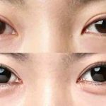 哪些人不适合注射卧蚕？注射丰卧蚕后注意事项！