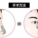 鼻小柱延长用耳软骨效果好吗？鼻小柱延长两个后遗症术前须知
