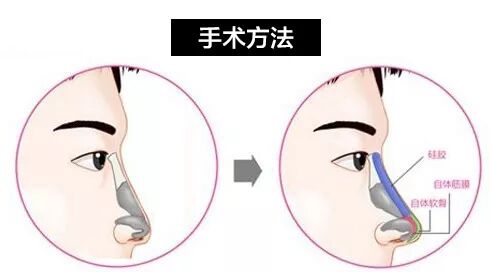 鼻小柱延长用耳软骨效果好吗？鼻小柱延长两个后遗症术前须知