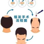 陈丽权做植发技术怎么样？深度分析_发际线高、头顶稀疏必看指南！