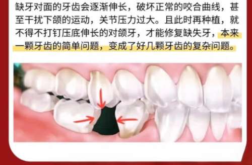 齐齐哈尔种植牙多少钱一颗？2026价格表新鲜出炉！