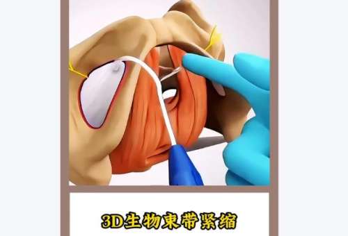 2026西京医院私密紧致手术价位多少？激光紧致3千元起\生物束带1.5万元起