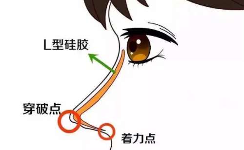 北京刘彦军做鼻子风格是怎么样的?案例点评