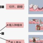 北京种牙多少钱一颗啊？2026牙科种植牙收费价目表更新！