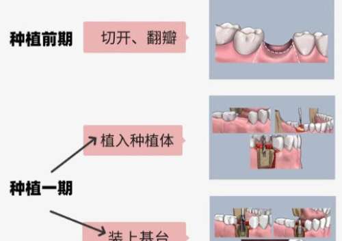 北京种牙多少钱一颗啊？2026牙科种植牙收费价目表更新！