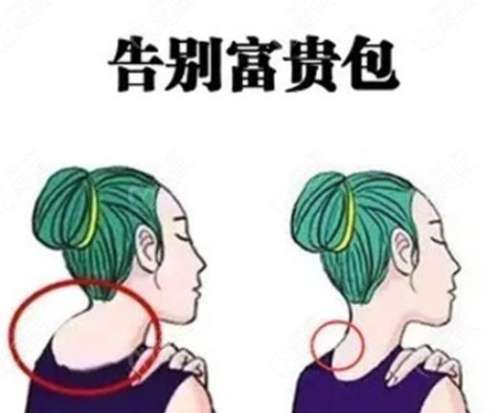 宁波富贵包吸脂手术价格？吸脂单价及医院收费明细