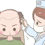 柳州工人医院植发多少钱？本地植发低至7k起！脱发必看指南！