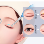 北京八大处双眼皮修复多少钱？整体花费大概多少？术前预算指南