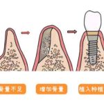 拉萨种植牙一颗多少钱？价格低至3k起含宝藏医院推荐！