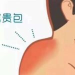 闫存礼医生富贵包手术评价咋样？宝鸡妇幼“精准抽吸技术派”，网友反馈：术后第二天就出院！