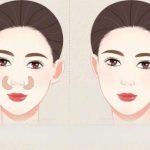 杭州peek鼻基底价格多少？3万元起，费用与靠谱医院选择参考