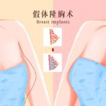 深圳哪家整形医院可以快速丰胸有效果？隆胸常见误区