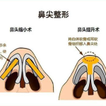 鼻尖整形的优势有哪些？鼻尖整形材料