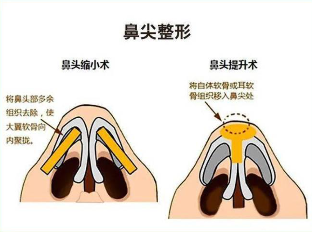 鼻尖整形的优势有哪些？鼻尖整形材料