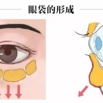 吸脂去眼袋的价格是多少？四大吸脂去眼袋的优势在这里