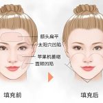 自体脂肪填充全脸痛吗？科普自体脂肪填充过多的补救方法