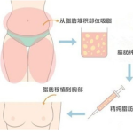 长沙自体脂肪隆胸多少钱？2026真实价格参考