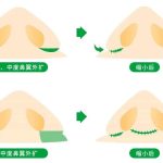 鼻头缩小有哪些危害？三个方式让鼻头缩小手术恢复好一些