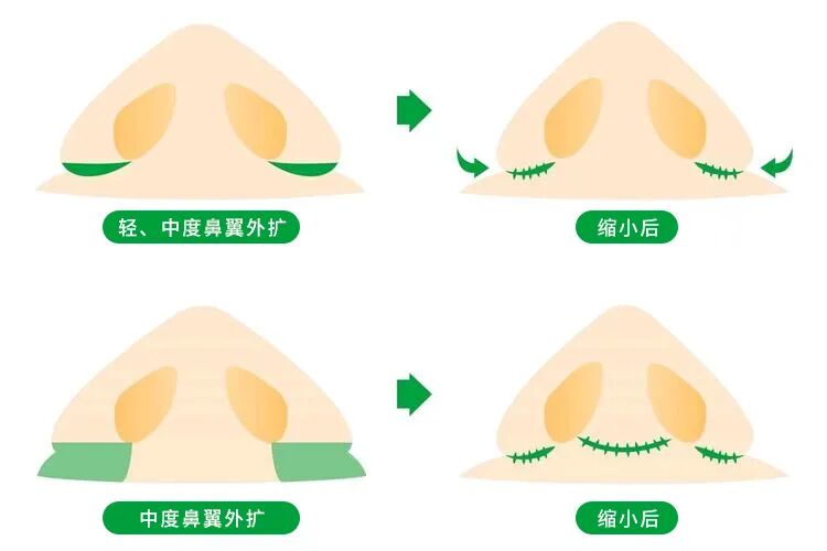 鼻头缩小有哪些危害？三个方式让鼻头缩小手术恢复好一些