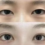 上海双眼皮价格是多少？解析影响双眼皮价格的4大因素