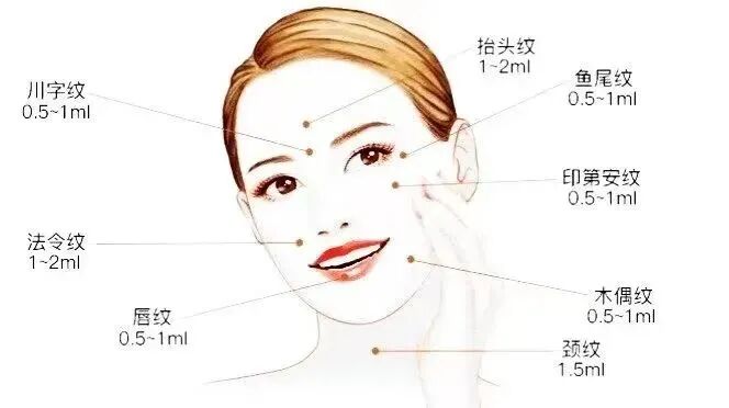 玻尿酸除皱医院哪家好？自体脂肪苹果肌
