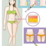 大腿吸脂术后的护理要点有哪些？大腿吸脂手术原理