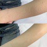 激光脱毛医院哪家好？激光脱毛好不好