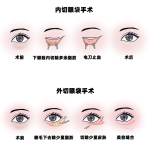 长沙去眼袋手术价格行情分析，贵不贵看完你就懂