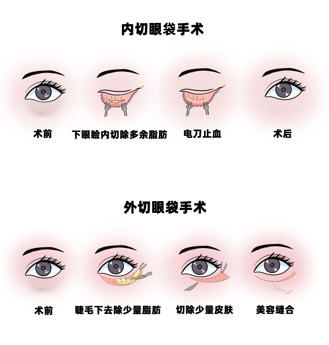 长沙去眼袋手术价格行情分析，贵不贵看完你就懂