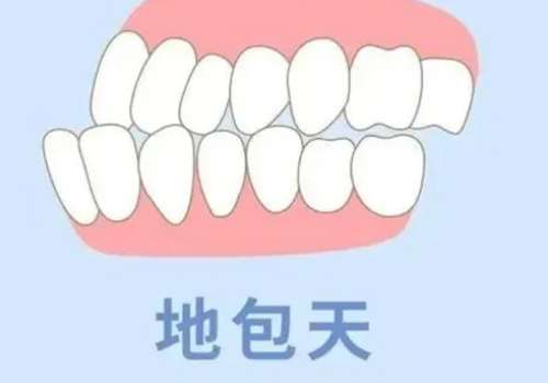 苏州地包天矫正需要多少钱？1万元到6万元不等，正规机构明码标价