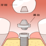 长沙种植牙齿多少钱一颗？不同品牌、方案、医院收费差距有多大