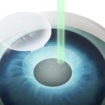 中山眼科中心飞秒手术费用是多少？2026版价格大概在1w起
