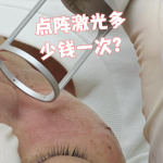 上海第八人民医院点阵激光多少钱？内附真实案例+收费明细+省钱攻略