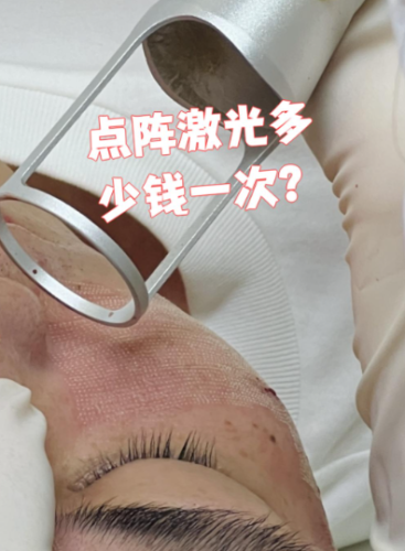 上海第八人民医院点阵激光多少钱？内附真实案例+收费明细+省钱攻略