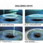 郑大一带院近视手术多少钱？2026年价格全揭秘，看完这篇再决定！