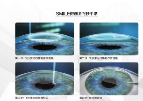 郑大一带院近视手术多少钱？2026年价格全揭秘，看完这篇再决定！
