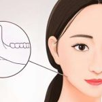 宁波磨骨手术费价格表！磨骨术前准备工作！