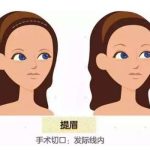 中日友好医院提眉多少钱？5000元起，靠谱医生、案例曝光，附价格表