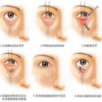 长春铭医做眼袋多少钱？激光3千元起\内切4千起\综合抗衰1.2万元起