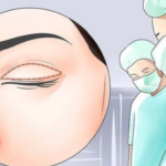 东莞人民医院双眼皮修复多少钱？常见问题修复方案+价格区间