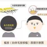 深圳比奥芳华综合门诊收费-FUE微针发际线种植\头顶加密8-20元/单位