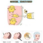 杭州张艺腾吸脂怎么样？高级美学设计、技术在线，腰腹环吸6800元起
