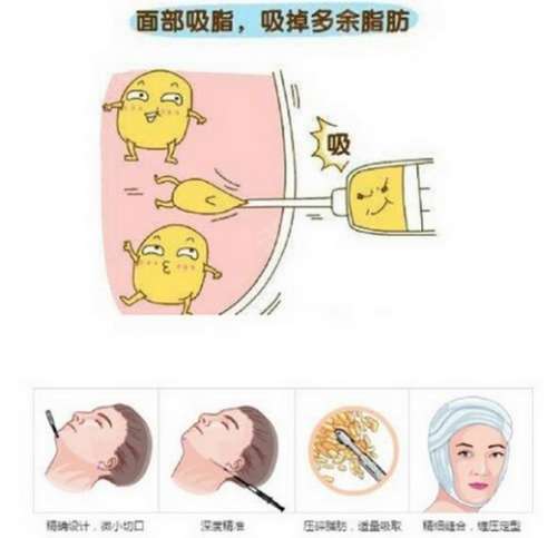 杭州张艺腾吸脂怎么样？高级美学设计、技术在线，腰腹环吸6800元起