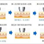 深圳黄金微针多少钱做一次？富华\非凡\米兰柏羽等，价格3千-8千元不等