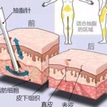 郭震宇医生吸脂评价咋样？上海老牌专家人气高，网友反馈：36年经验效果稳！