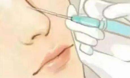 南宁注射隆鼻多少钱？附属一院、瑞康医院等高性价比机构！