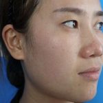 张振宇双眼皮图片，真人分享全切双眼皮前后对比图