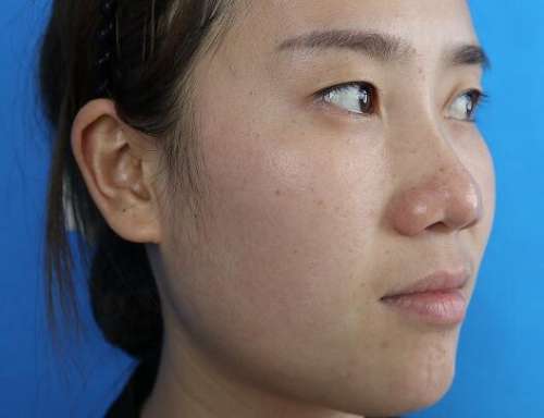 张振宇双眼皮图片，真人分享全切双眼皮前后对比图